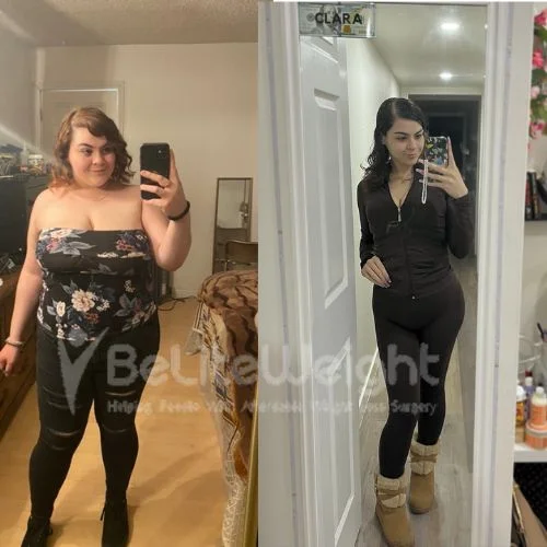 Clara C - RNY gastric bypass update after 3 years*